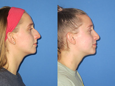 Before After Images rhinoplasty