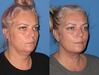 Before After Images necklift