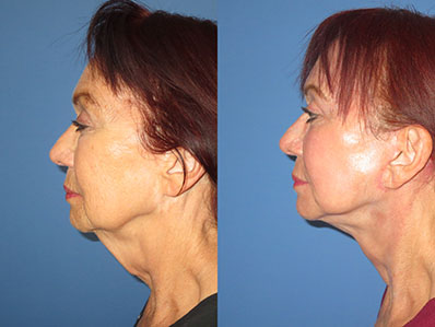 Before After Images