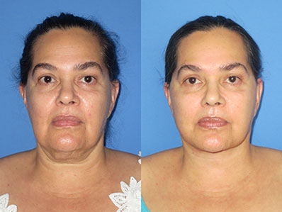 Before After Images chin augmentation