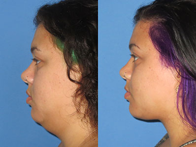 Before After Images chin augmentation