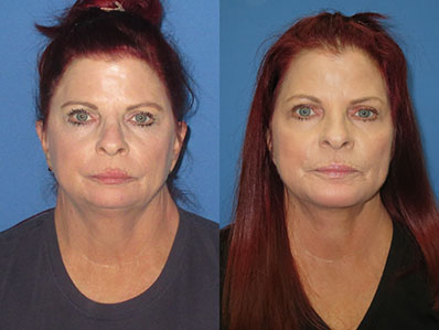 Before After Images neck lift and chin augmentation