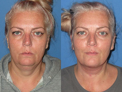 Before After Images necklift
