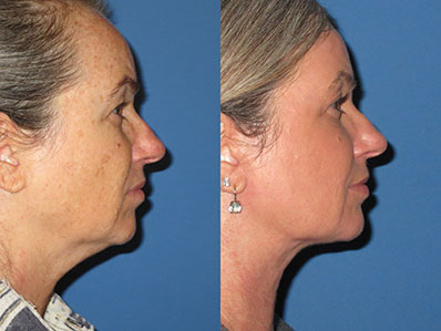 Before After Images Necklift