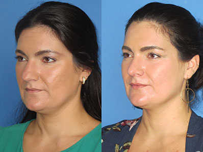 Before After Images nose job