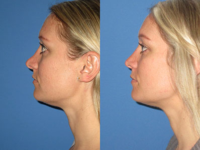 Before After Images nose job