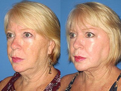 Before After Images neck lift