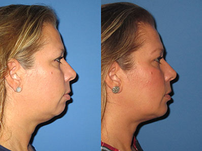 Before After Images chin implant